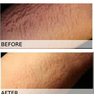 Stretch-Mark-Remover-(Before-&-After)