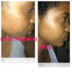 Acne-Cream-(Before-and-After-Treatment)